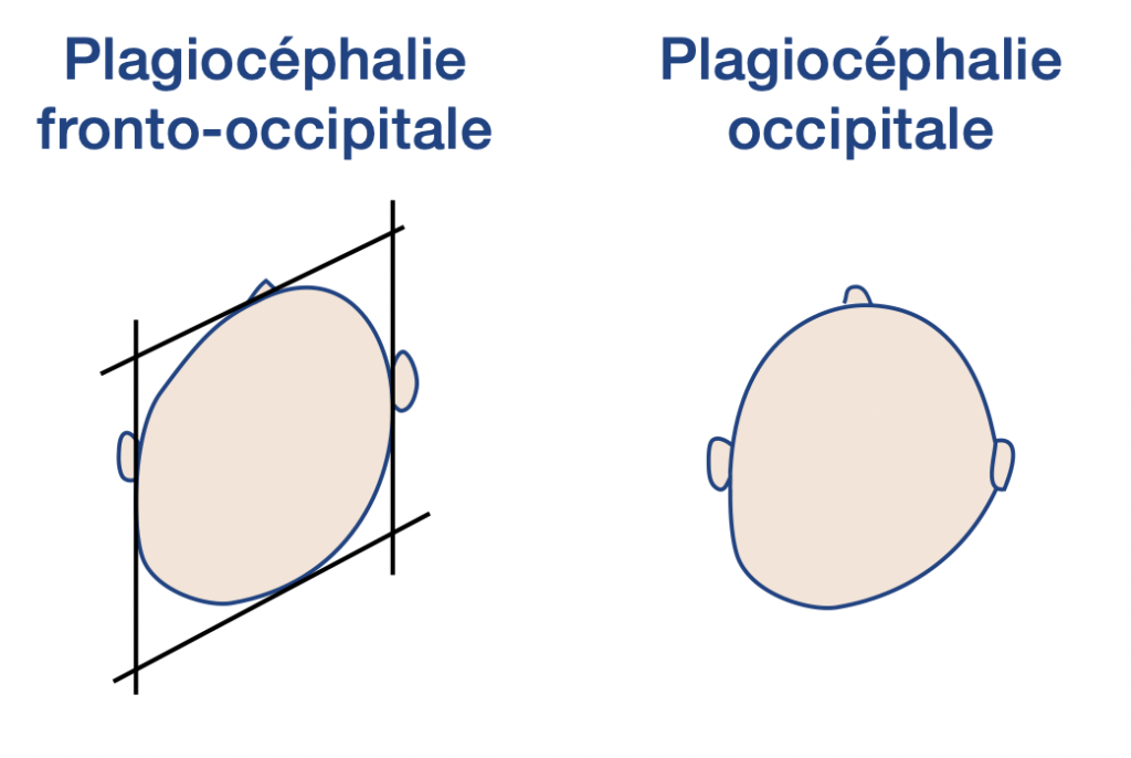 plagiocpéhalie ostéopathie